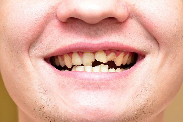 How Your Dentist Can Fix A Broken Tooth