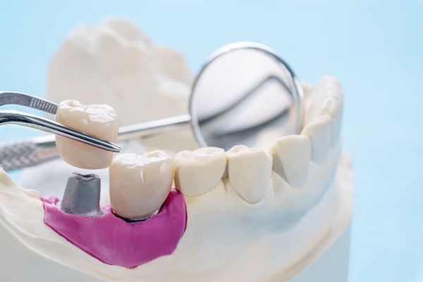 Dental Crown Placement To Restore Damaged Teeth