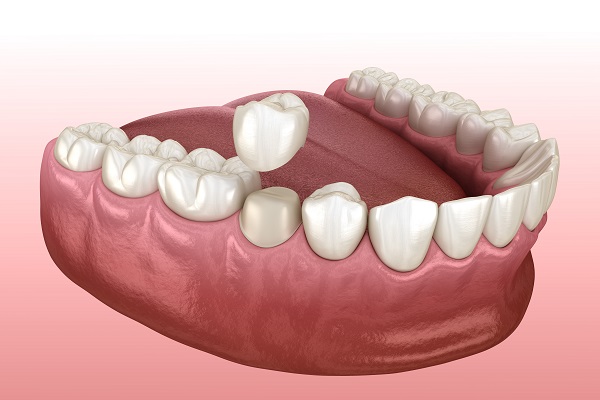 Dental Crowns To Protect Your Tooth