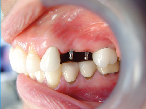 How Are Mini Dental Implants Done?