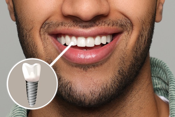 Tooth Replacement &#    ; The Steps For A Dental Implant Procedure