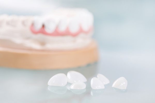 Signs You Are A Candidate For Dental Veneers