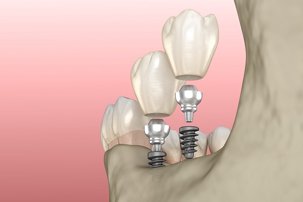 When Are Mini Dental Implants Recommended?