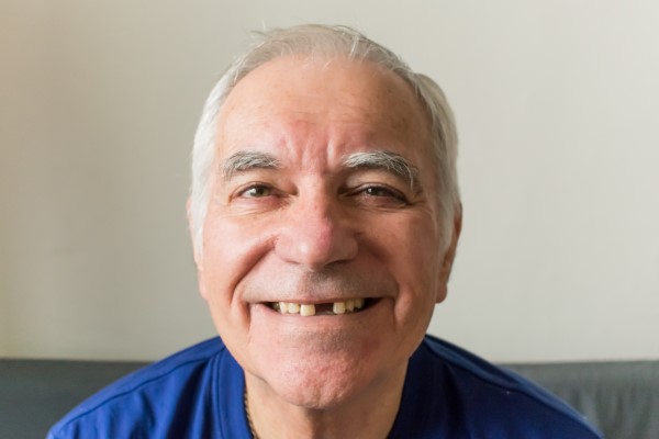 Are Partial Dentures Used For One Missing Tooth?