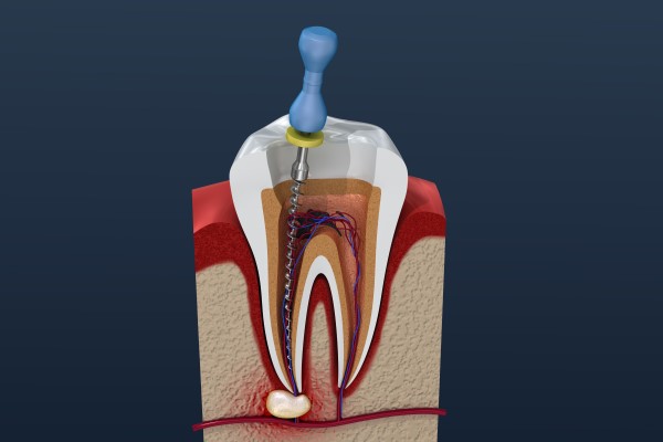 How A Root Canal Can Save Your Tooth