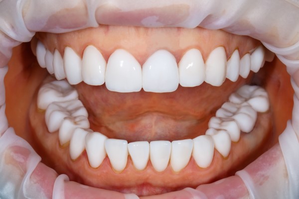 The Role Veneers Play In A Smile Makeover