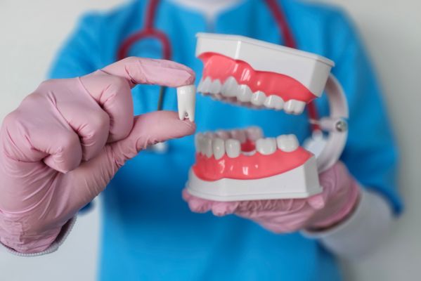 Tooth Extractions Before Dental Implants: What To Know