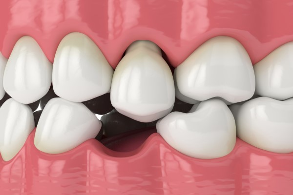 Regain Your Smile And Oral Function With A Tooth Replacement