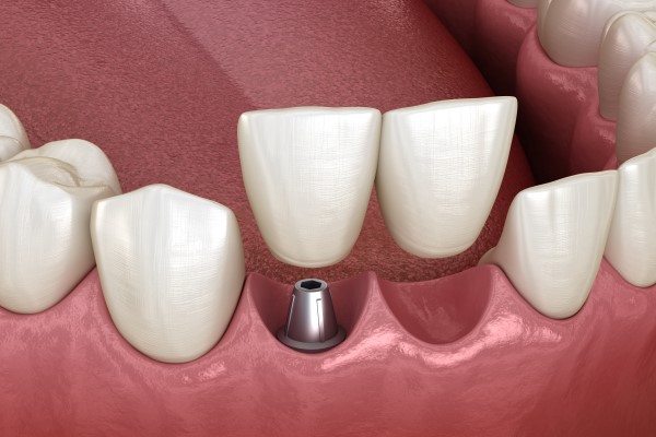 How Tooth Replacement Enhances Oral Health And Confidence